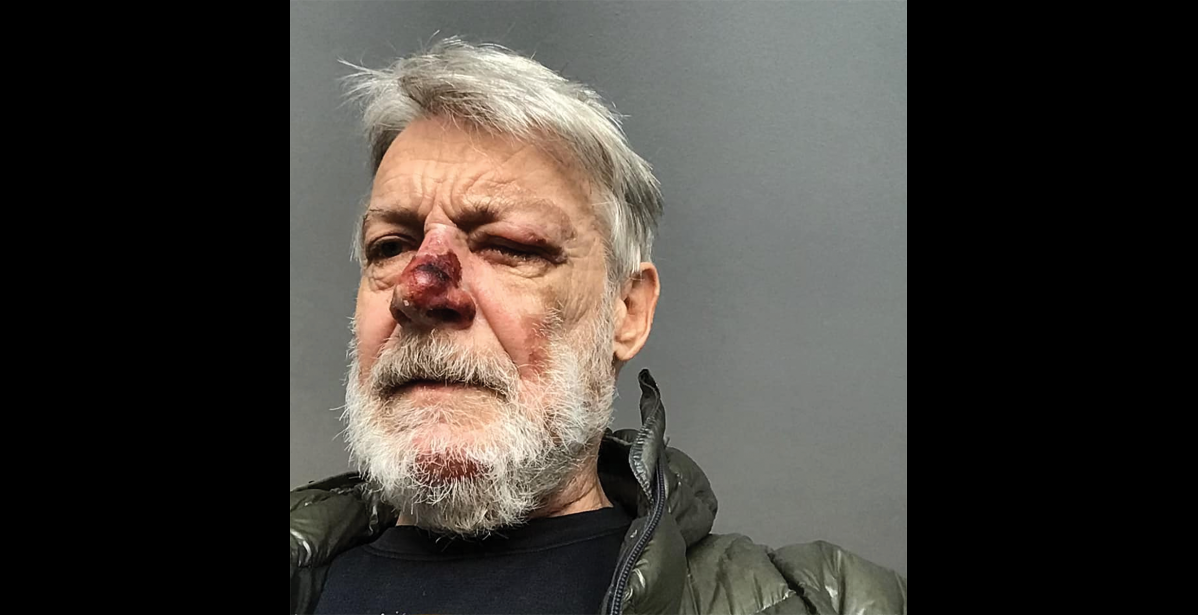 Photo courtesy Tim Hewitt FROSTBITE—Tim Hewitt's face shows frostbite injuries.